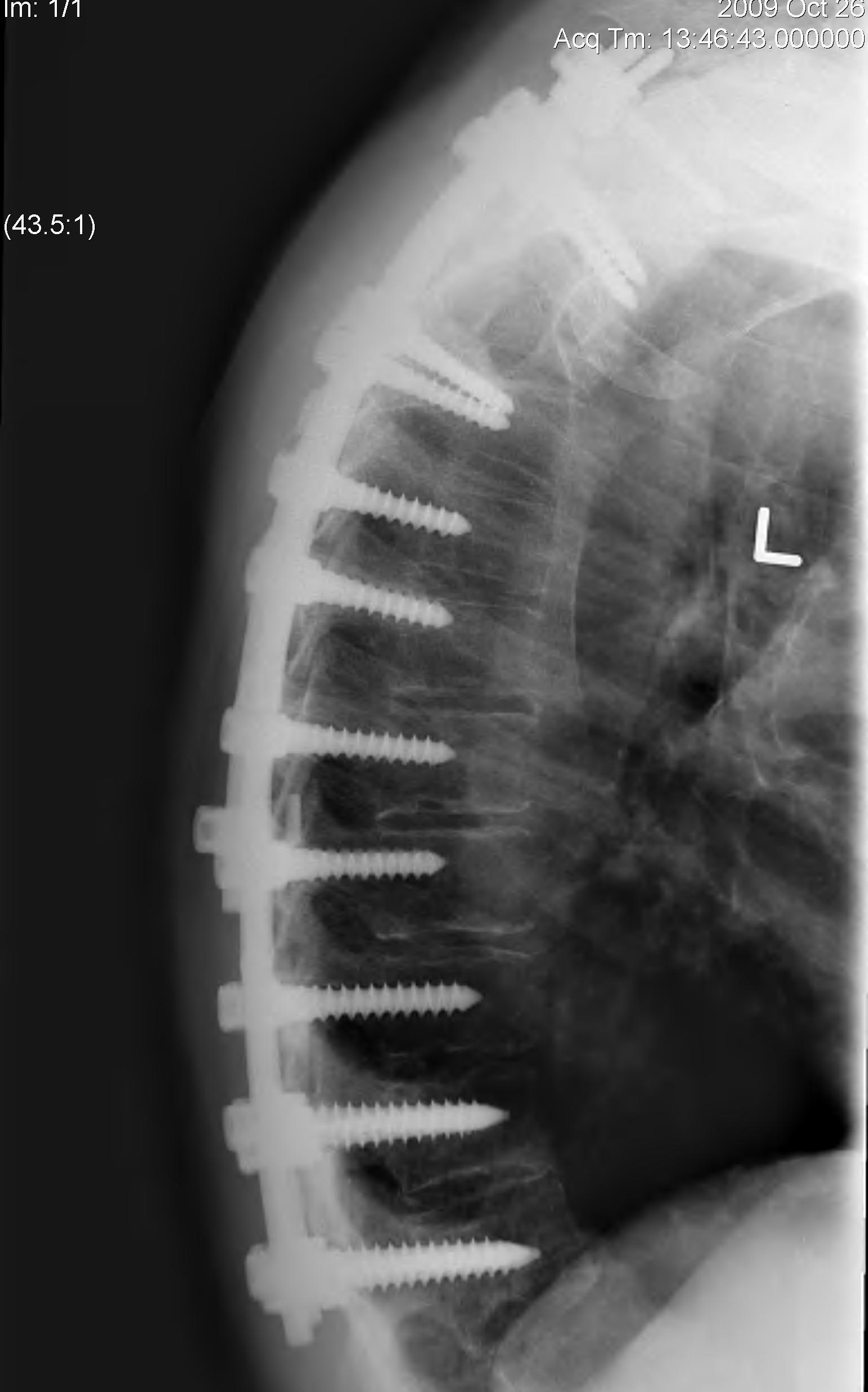 Thoracic Spine Pathological Fracture Stabilisation